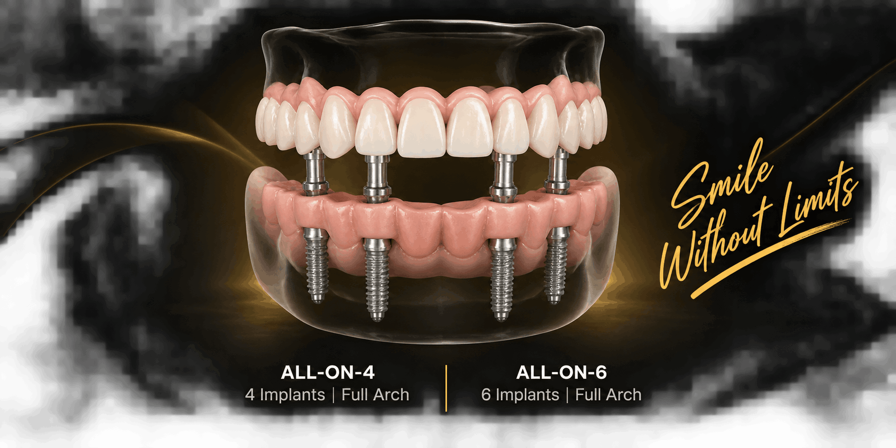 best all & 4 and 6 implant in gwalior