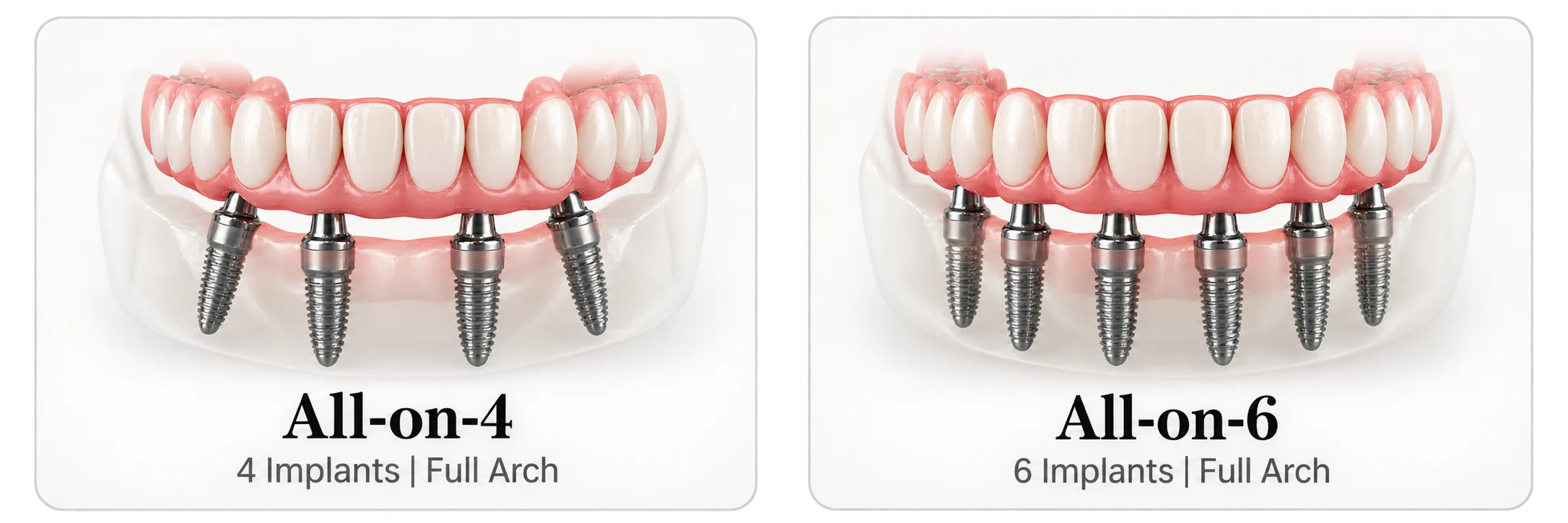 All on 4 or All on 6 implants in Gwalior