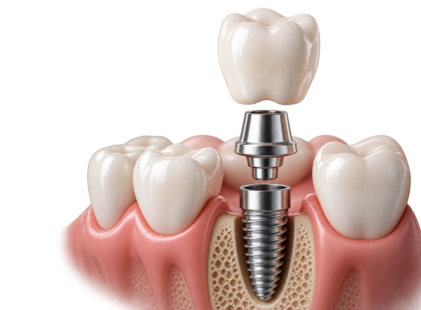 Implant Support Dentures