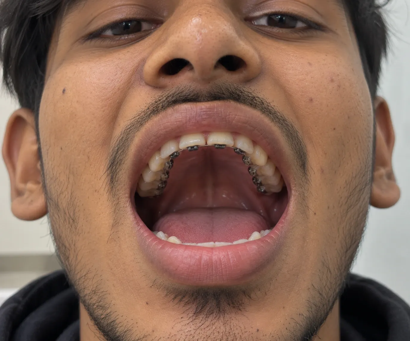 bylingual braces in gwalior